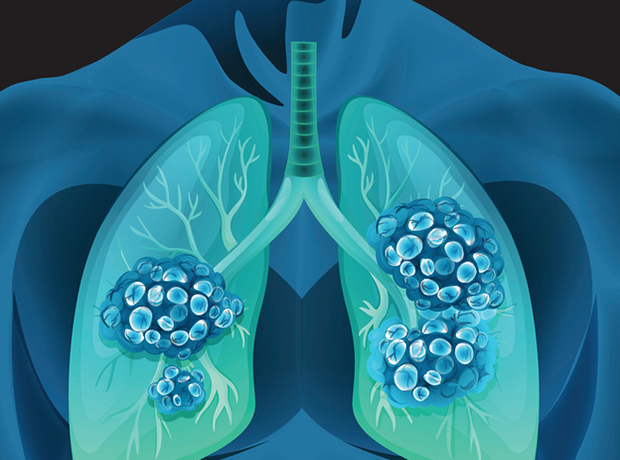 rassegna stampa cancro polmone